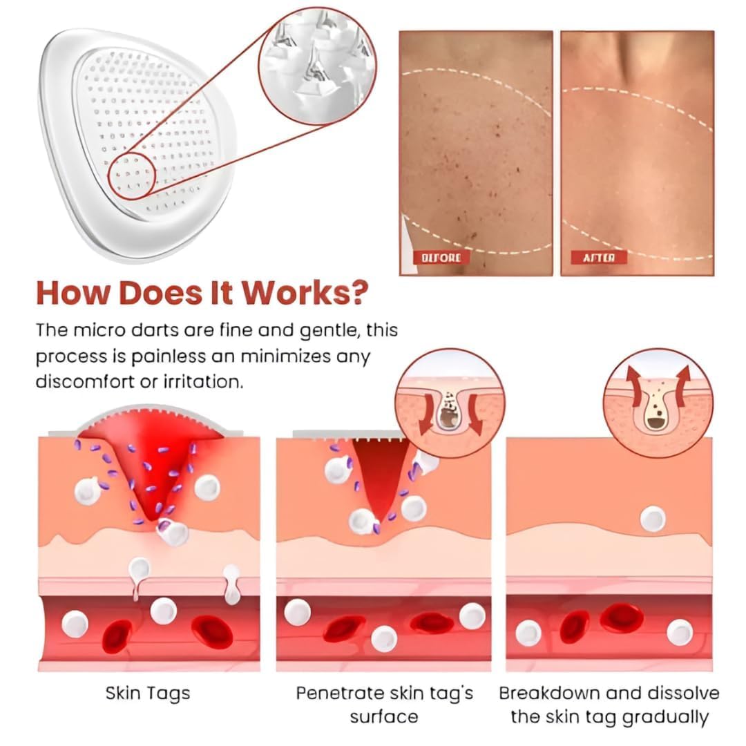 DermaPatch™ Skin Tag Remover