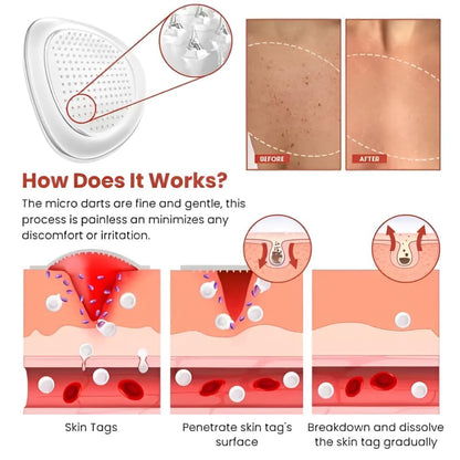 DermaPatch™ Skin Tag Remover